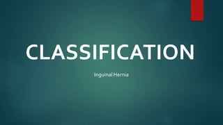 CLASSIFICATION
Inguinal Hernia
 