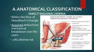 A.ANATOMICAL CLASSIFICATION
DIRECT INGUINAL HERNIA
Within the floor of
Hesselbach’s triangle
Acquired defectfrom
mechanical
breakdown over the
years
~1% Lifetime risk
 