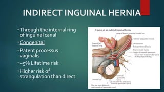 INDIRECT INGUINAL HERNIA
Through the internal ring
of inguinal canal
Congenital
Patent processus
vaginalis
~5% Lifetime risk
Higher risk of
strangulation than direct
 