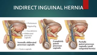 INDIRECT INGUINAL HERNIA
 