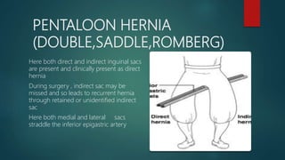 PENTALOON HERNIA
(DOUBLE,SADDLE,ROMBERG)
Here both direct and indirect inguinal sacs
are present and clinically present as direct
hernia
During surgery , indirect sac may be
missed and so leads to recurrent hernia
through retained or unidentified indirect
sac
Here both medial and lateral sacs
straddle the inferior epigastric artery
 