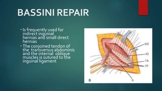 BASSINI REPAIR
 Is frequently used for
indirect inguinal
hernias and small direct
hernias
 The conjoined tendon of
the transversus abdominis
and the internal oblique
muscles is sutured to the
inguinal ligament
 