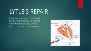LYTLE’S REPAIR
Only internal ring is narrowed
by placing interrupted sutures
over the medial side of the
ring to the fascia transversalis
 