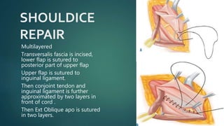SHOULDICE
REPAIR
Multilayered
Transversalis fascia is incised,
lower flap is sutured to
posterior part of upper flap
Upper flap is sutured to
inguinal ligament.
Then conjoint tendon and
inguinal ligament is further
approximated by two layers in
front of cord .
Then Ext Oblique apo is sutured
in two layers.
 