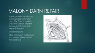 MALONY DARN REPAIR
Posterior wall is re-inforced
with monofilament nylon
darn. The Darn is made in
crisscross fashion between
the conjoint tendon and
inguinal ligament
Excellent results.
Most commonly performed
in countries where mesh is
too expensive
 