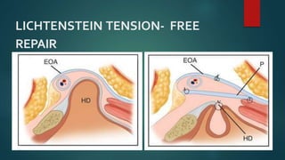 LICHTENSTEIN TENSION- FREE
REPAIR
 