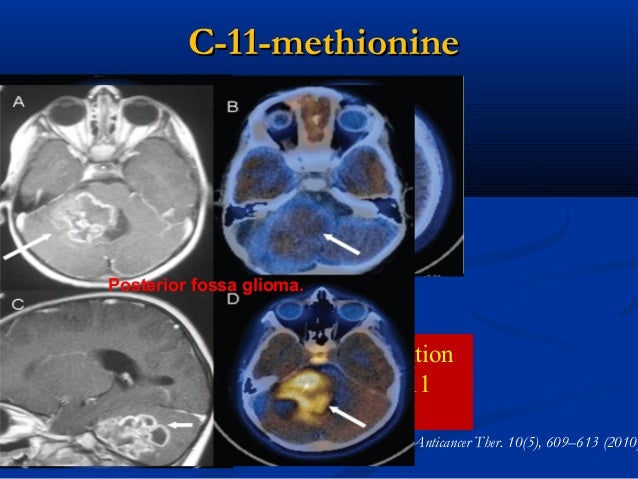 read parp inhibitors for cancer