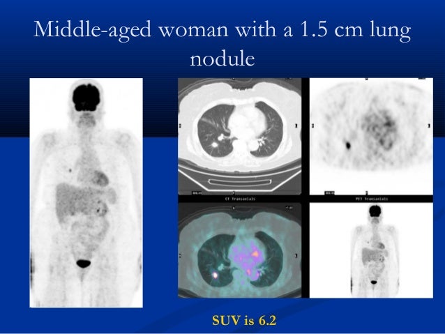 Middle Aged Patient With A 1 4 Cm Lung Nodule Suv Is 1 2 Middle Aged Patient With A 1 4 Cm Lung Nodule Suv Is 1 2