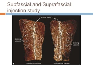 Subfascial and Suprafascial
injection study
 