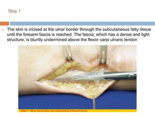 Step 1
 The skin is incised at the ulnar border through the subcutaneous fatty tissue
until the forearm fascia is reached. The fascia, which has a dense and tight
structure, is bluntly undermined above the flexor carpi ulnaris tendon
 