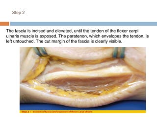Step 2
The fascia is incised and elevated, until the tendon of the flexor carpi
ulnaris muscle is exposed. The paratenon, which envelopes the tendon, is
left untouched. The cut margin of the fascia is clearly visible.
 