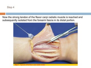 Step 4
Now the strong tendon of the flexor carpi radialis muscle is reached and
subsequently isolated from the forearm fascia in its distal portion.
 