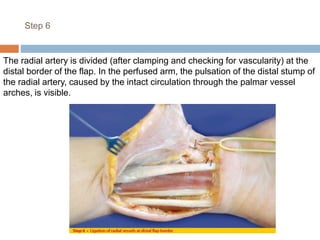 Step 6
The radial artery is divided (after clamping and checking for vascularity) at the
distal border of the flap. In the perfused arm, the pulsation of the distal stump of
the radial artery, caused by the intact circulation through the palmar vessel
arches, is visible.
 