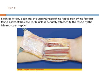 Step 9
It can be clearly seen that the undersurface of the flap is built by the forearm
fascia and that the vascular bundle is securely attached to the fascia by the
intermuscular septum.
 