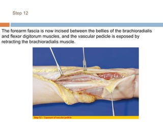 Step 12
The forearm fascia is now incised between the bellies of the brachioradialis
and flexor digitorum muscles, and the vascular pedicle is exposed by
retracting the brachioradialis muscle.
 