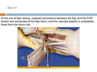 Step 14
At the end of flap raising, residual connections between the flap and the FCR
tendon are transected at the flap hilum, and the vascular pedicle is completely
freed from the donor site.
 