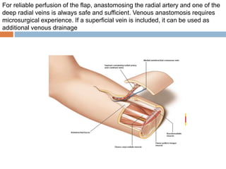For reliable perfusion of the flap, anastomosing the radial artery and one of the
deep radial veins is always safe and sufficient. Venous anastomosis requires
microsurgical experience. If a superficial vein is included, it can be used as
additional venous drainage
 