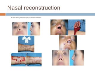 Nasal reconstruction
 