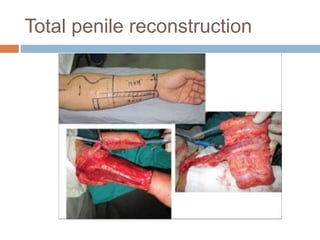 Total penile reconstruction
 