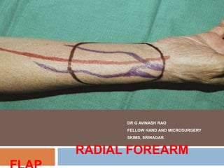 DR G AVINASH RAO
FELLOW HAND AND MICROSURGERY
SKIMS, SRINAGAR.
RADIAL FOREARM
 