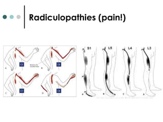 Radiculopathies (pain!)
 