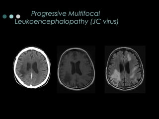 Progressive Multifocal
Leukoencephalopathy (JC virus)
 