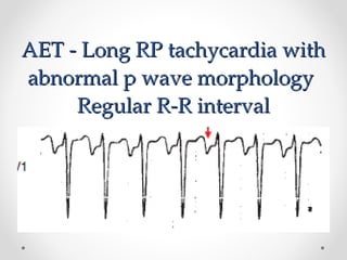 Long Rp Example dr haider ali 2.ppt on svt and case study | PPT