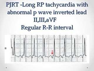dr haider ali 2.ppt on svt and case study | PPT