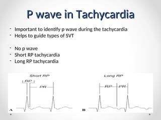 dr haider ali 4.ppt on svt case study and | PPT