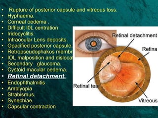 Congenital cataract | PPT