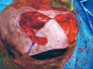Head and Neck Melanoma | PPT