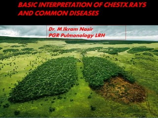 Dr. M.Ikram Nasir
PGR Pulmonology LRH
BASIC INTERPRETATION OF CHESTX.RAYS
AND COMMON DISEASES
 