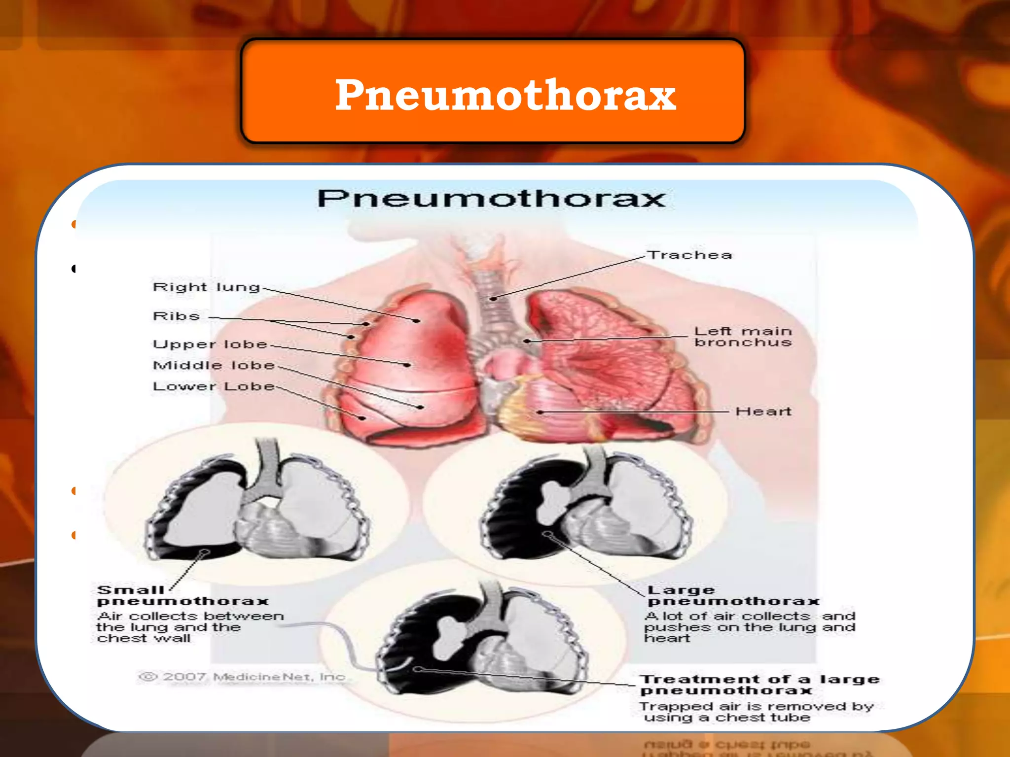 Pneumothorax
• Pneumothorax
• laterally means (air in the chest).

• There are many type of pneumothorax:
• Traumatic pneumothorax :is that results from injury to the
pleura, with air introduced into the pleural space .

 