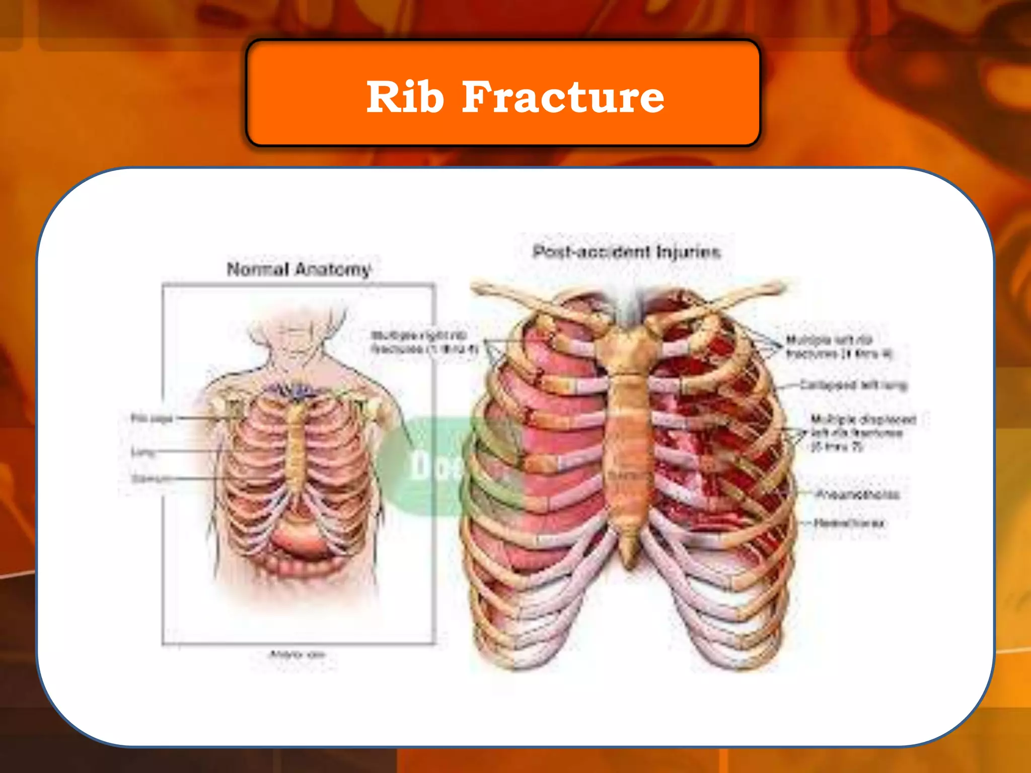 Rib Fracture

 