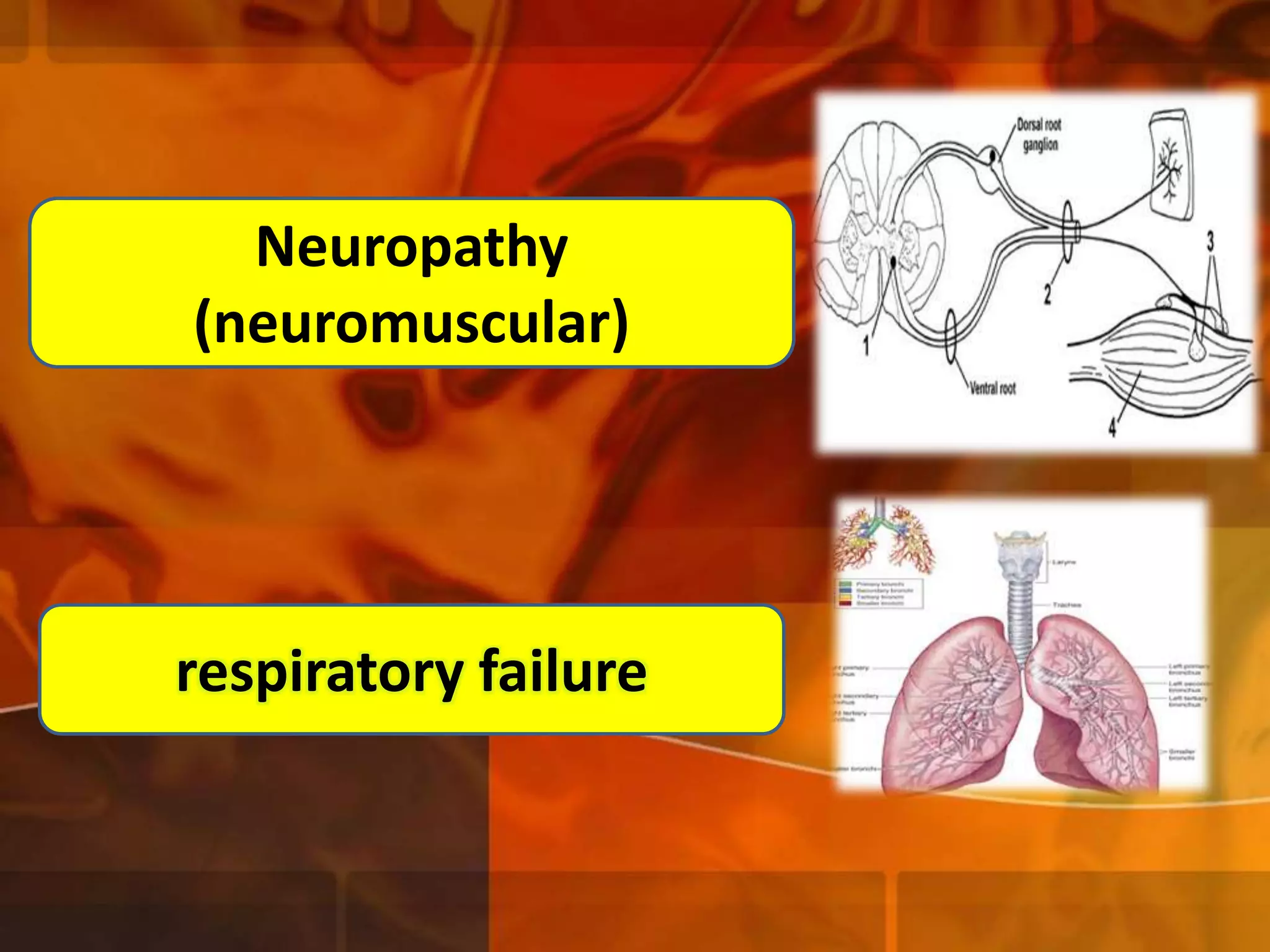 Neuropathy
(neuromuscular)

respiratory failure

 