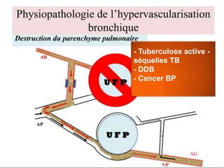 - Tuberculose active -
séquelles TB
- DDB
- Cancer BP
 