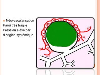  Néovascularisation
Paroi très fragile
Pression élevé car
d’origine systémique
 