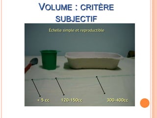 VOLUME : CRITÈRE
         SUBJECTIF
     Échelle simple et reproductible




< 5 cc     120-150cc                   300-400cc
 