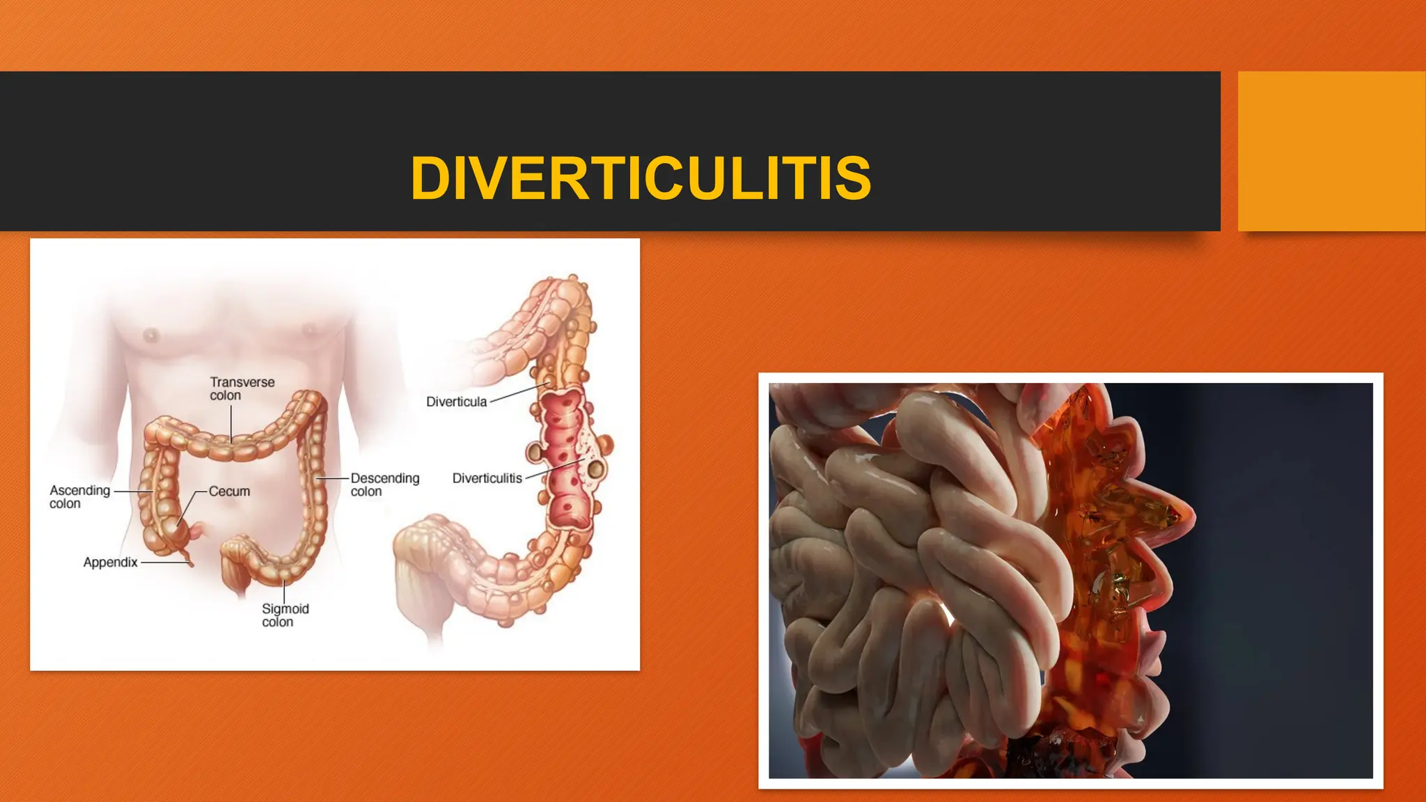 DIVERTICULITIS
 