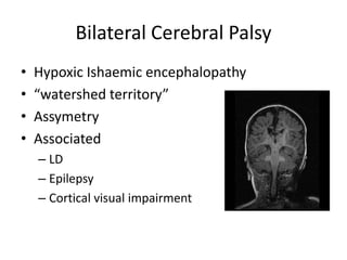 Bilateral Cerebral Palsy
•   Hypoxic Ishaemic encephalopathy
•   “watershed territory”
•   Assymetry
•   Associated
    – LD
    – Epilepsy
    – Cortical visual impairment
 