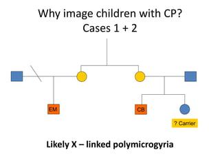 Why image children with CP?
       Cases 1 + 2




  EM                   CB

                                    ? Carrier



 Likely X – linked polymicrogyria
 