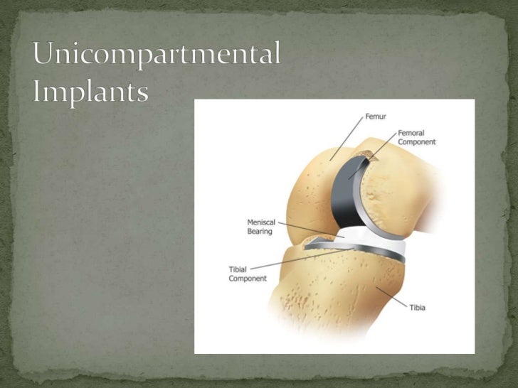 Dr Jones Knee Joint Replacement