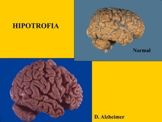 HIPOTROFIA
Normal
D. Alzheimer
 