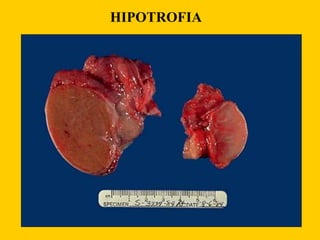 HIPOTROFIA
 