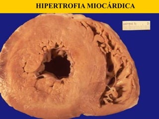 HIPERTROFIA MIOCÁRDICA
 