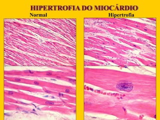 HIPERTROFIA DO MIOCÁRDIO
Normal Hipertrofia
 