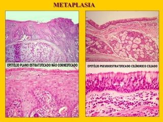 METAPLASIA
 