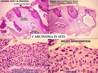 CARCINOMA IN SITU
 