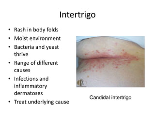 Sweat Rash Intertrigo SKIN INFECTIONS WITH MANAGMENT | PPT