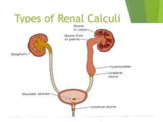 Types of Renal Calculi
 